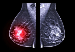 内江市妇幼保健院专家解读：乳腺结节与乳腺癌有关吗？